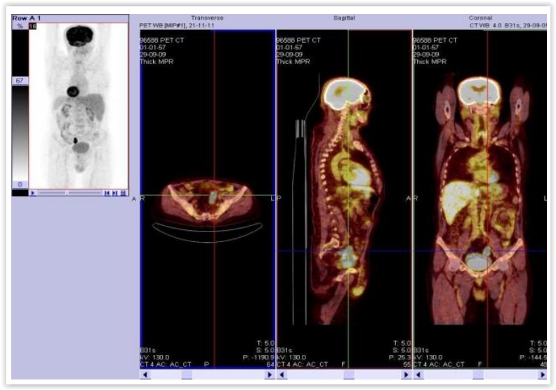 Beyin metastazı olan ve primeri tespit edilemeyen hastanın PET/BT görüntüsünde sigmoid kolon tutulumu. (Beyin metastazı: Denge kaybı ve yürüyememe şikayeti ile başvuran hastanın çekilen cerebral MR’ında cerebellar kitle saptanması üzerine kitle eksize edilmiş ve patoloji sonucu karsinom metastazı olarak gelmiş. Yapılan rutin tetkiklerinde primer odak bulunamayan hastanın PET/BT görüntüsünde sigmoidde artmış tutulum izlendi ve primer sigmoid kolon karsinomu tanısı aldı).