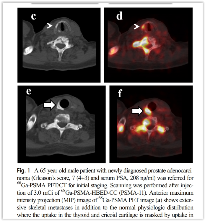 Prostat Adenokarsinom Vakasında 68Ga-PSMA PET/BT ile Tespit Edilen ...