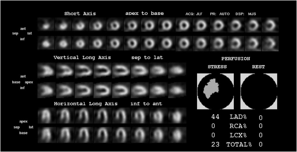 Bu hasta KABG sonrası kardiyak rehabilitasyon sırasında tekrarlayan anjina benzeri göğüs ağrısı atakları yaşamıştır. Anger SPECT, apekste, LIMA grefti dağılımında geri dönüşümlü bir perfüzyon defekti gösterdi. Tarama, sonraki koroner ve bypass greft anjiyografisinde bulunan LIMA-LAD anastomoz darlığı olasılığını düşündürdü. Anastomoz stentlendi ve hastanın semptomları düzeldi.